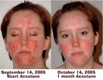 acne accutane price