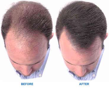 propecia finasteride